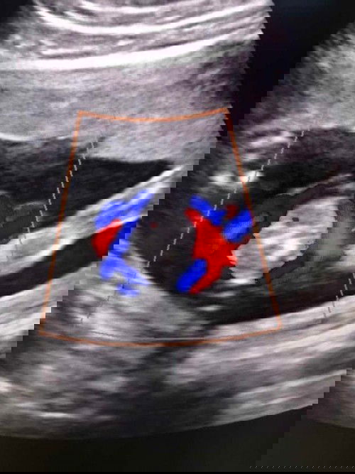 ตอนนี้ตั้งครรภ์ได้ 20วีคละค่ะ แต่วันนี้ไปซาวดูความสมบรูณ์ของลูกหมอบอกว่ารกพันคอลูกอยู่ แม่จิตตกมากค่ะกลัว