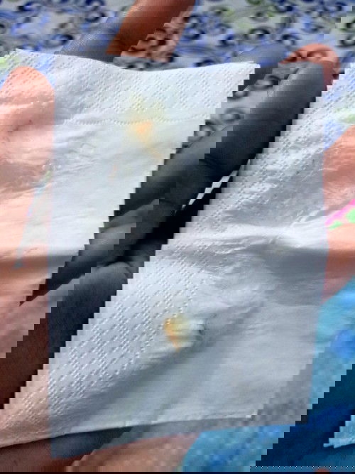 มูกใสมีเลือดปนออกมา