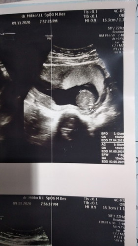 Perkiraan melahirkan saya kira2 yang mana ya bun? EDD nya ada 3 diketerangan. Mohon bantu.