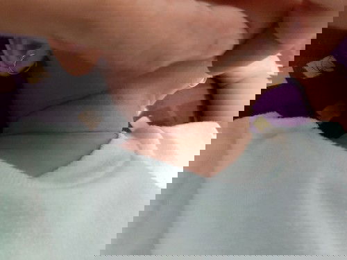 Kemerahan biang keringat