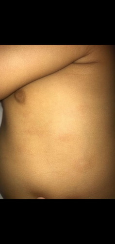 Naik bintik2 di badan