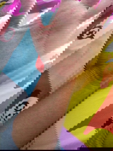 Ruam merah seluruh tubuh