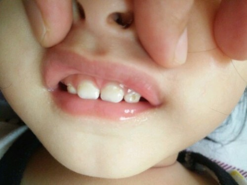 baby tooth decay