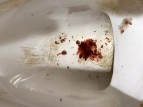 ท้อง39สัปดาห์ มีอาการท้องผูกตอนถ่ายครั้งแรก หลังจากนั่นก็ถ่ายออกมาตามรูปไม่แน่ใจว่าถ่ายเป็นเลือดไหม