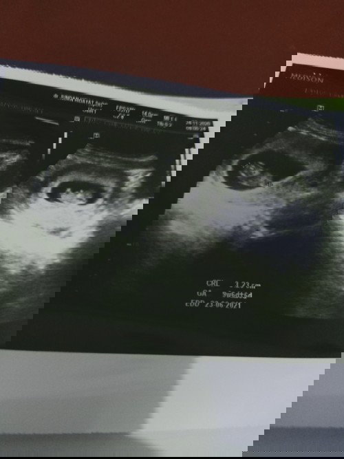 Sharing yuk bun kalo ada yang lagi hamil anak kembar 🤗