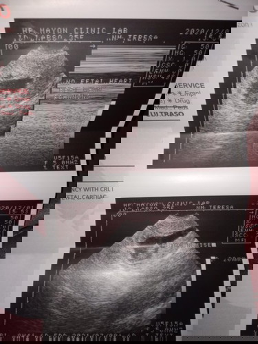 Pregnant for 11 weeks.