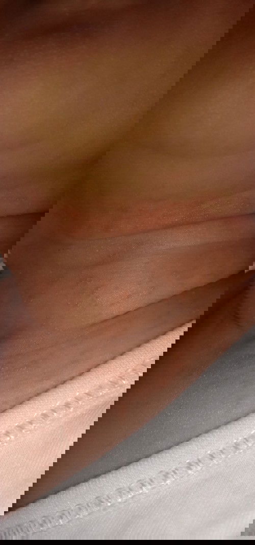 rashes po ba ang tawag dito?