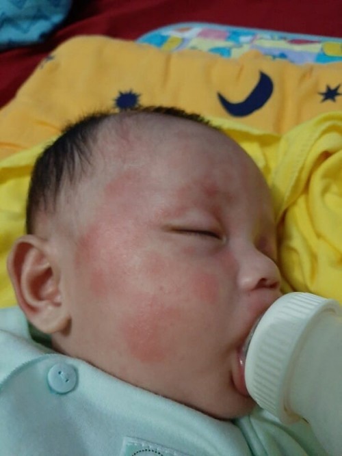 Ruam di wajah