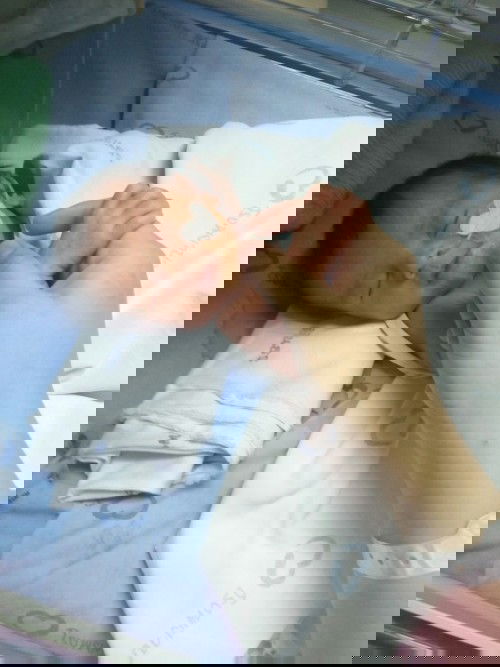 แอบแตกจ้า คลอดก่อนกำหนดเพราะครรภ์เป็นพิษ 35+4 week