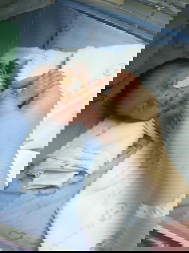 แอบแตกจ้า คลอดก่อนกำหนดเพราะครรภ์เป็นพิษ 35+4 week