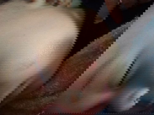 Alergi atau ruam asi?