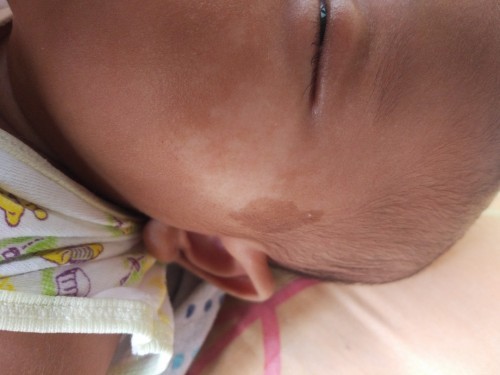 Bercak putih Di wajah