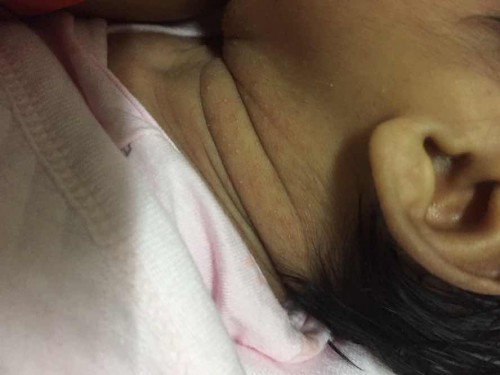 ขึ้นผื่นแบบนี้เป็นเพราะอะไรคะ