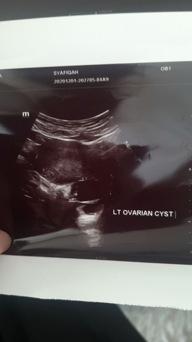 Kemunculan Cyst pada Minggu ke 5.