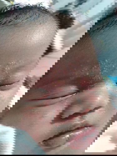 Rashes sa mukha nya