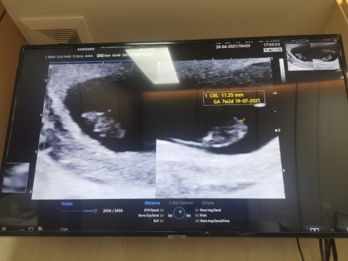 ไม่ได้ยินเสียงหัวใจ