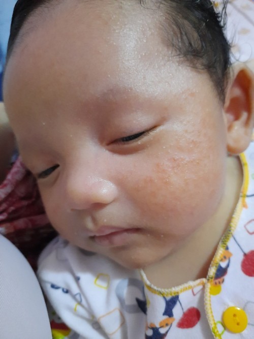 Alergi Asi mungkin karna makanan yg di konsumsi ibu