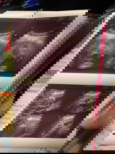 ผลอัลตาซาวออกแล้วค่ะ
