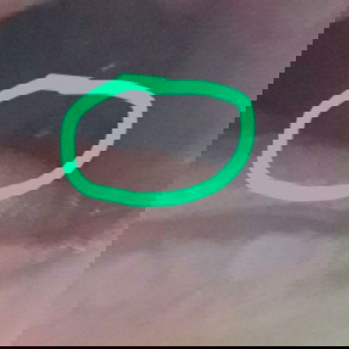 gusi gigi seperti benjolan