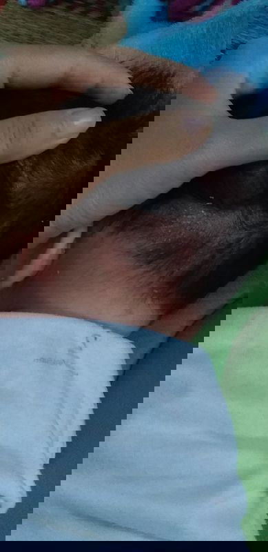 Bé bị gàu và đỏ