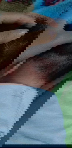 Bé bị gàu và đỏ