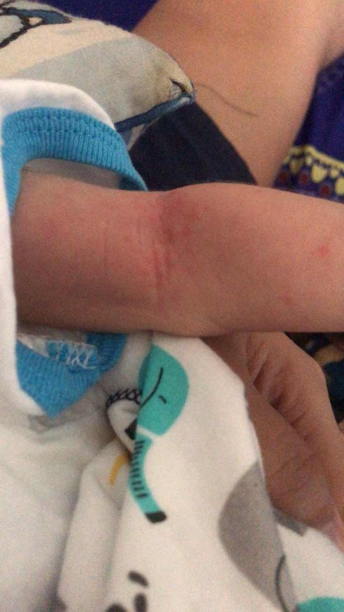 Bintik bintik merah di lipetan tangan dan leher biar cpt ilang di olesin apa ya bund