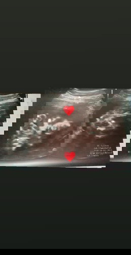 แม่ๆท้อง7เดือน น้ำหนักลูกในครรเท่าไหร่กันบ้างแล้วค่ะ บ้านนี้ลูก1,070g