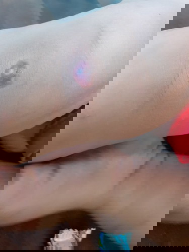 แผลที่เกิดจากอะไรไม่รู้