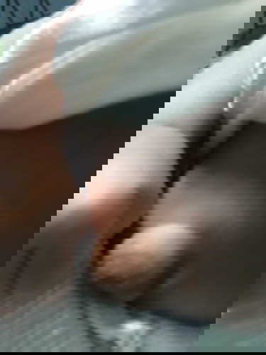 Pusod ni baby(hernia)