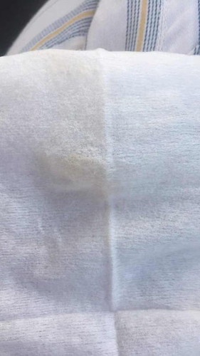 ใช้กระดาษทิชชู่เช็ดหลังปัสสาวะแล้วมีสีน้ำตาลอ่อนๆเป็นอะไรมั้ย