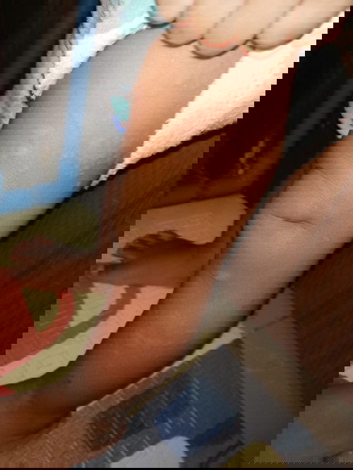 ลูกชายเป็นผื่นค่ะ