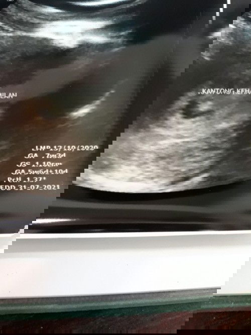 Hamil 7 minggu 3 hari