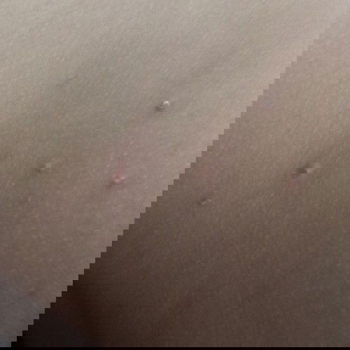 Bentol bintik selama hamil