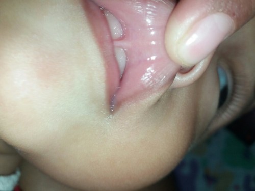 lip tie