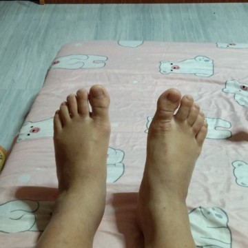 แม่ๆๆบ้านไหนเท้าบวมแบบนี้บ้างค่ะตอนนี้อายุครรภ์37w+2dแนะนำหน่อยค่ะ