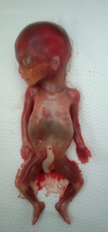 Goodbye My Baby Nisha Calixa 😭👼my 18weeks baby 😭