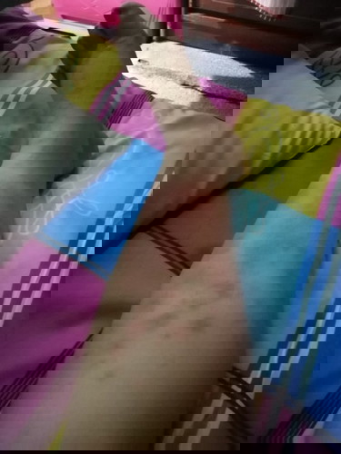 Rashes during pregnancy