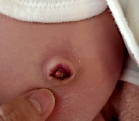 สดือน้องพึ่งหลุดเมื่อคืน เเต่ลักษณะแบบนี้ปกติไหมคะหรือว่าต้องไปหาหมอ