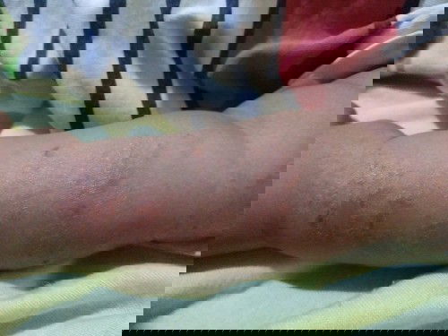 Eksim kulit atau alergi makanan