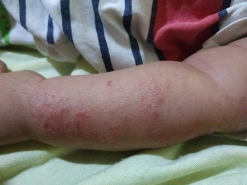 Eksim kulit atau alergi makanan