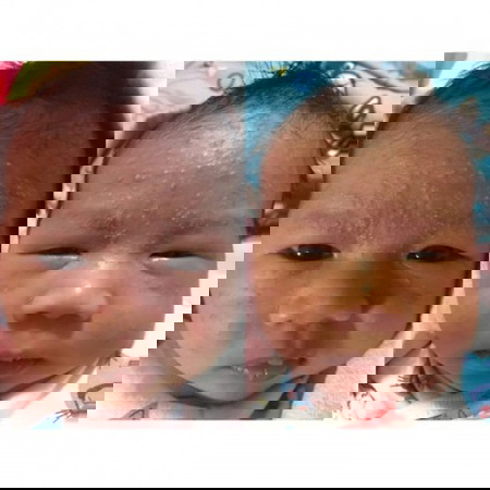 แนะทำทีค่ะ ลูกเป็นผดแบบนี้