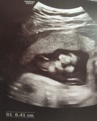 FALSE POSITIVE CLEFT LIP(CAS 2D). IS IT POSSIBLE? ANY SAME EXPERIENCE?