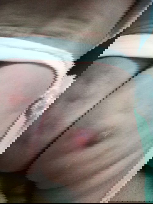 BCG vaccine sa puwet ni baby