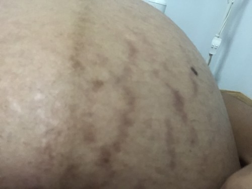 ยับเยินมาก คันยุบยิบตลอดเวลา