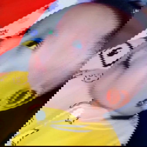 Pipi merah di gigit nyamuk