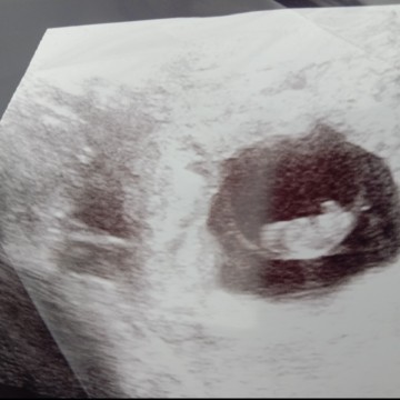 เมื่อฉันเกิดภาวะแท้งคุกคาม