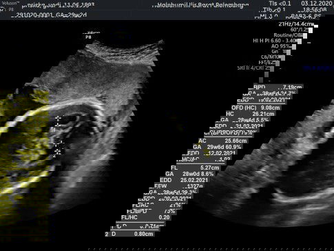 Hasil usg ada cairan dikepala.