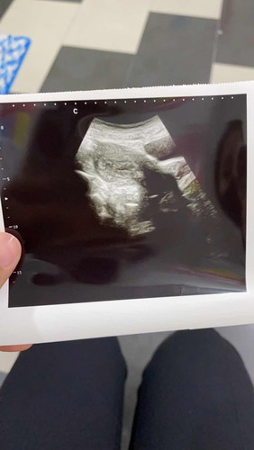 Doc kata gugur tapi saya takda simptom gugur pon. Sakit pon takda.