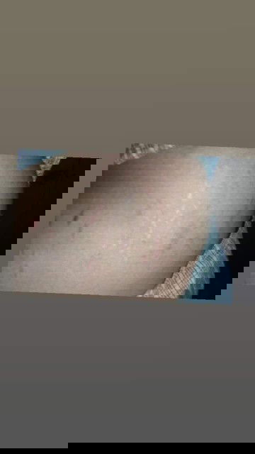 หน้าท้องแตกเป็นรอยแดงข้างๆเอวคลอดแล้วจะหายไหมหรือต้องใช้ครีมตัวไหนถึงจะหายค่ะ
#ขอคำเเนะนำหน่อยค่ะ