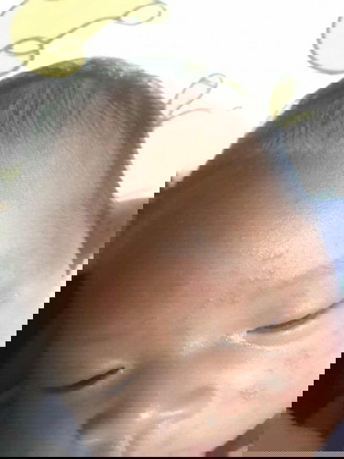 ผื่นขึ้นหน้าสอบถามแม่ๆ